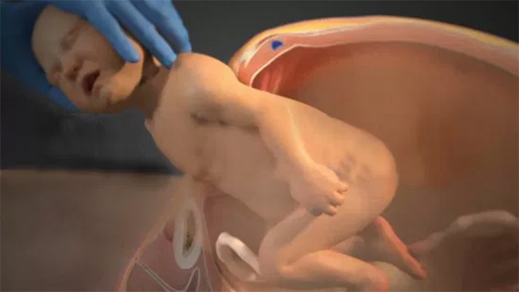 Caesarean: The Video That Will Remove all Doubts